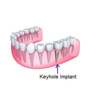 Keyhole Implant Placement