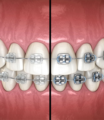 Metal and Ceramic Braces